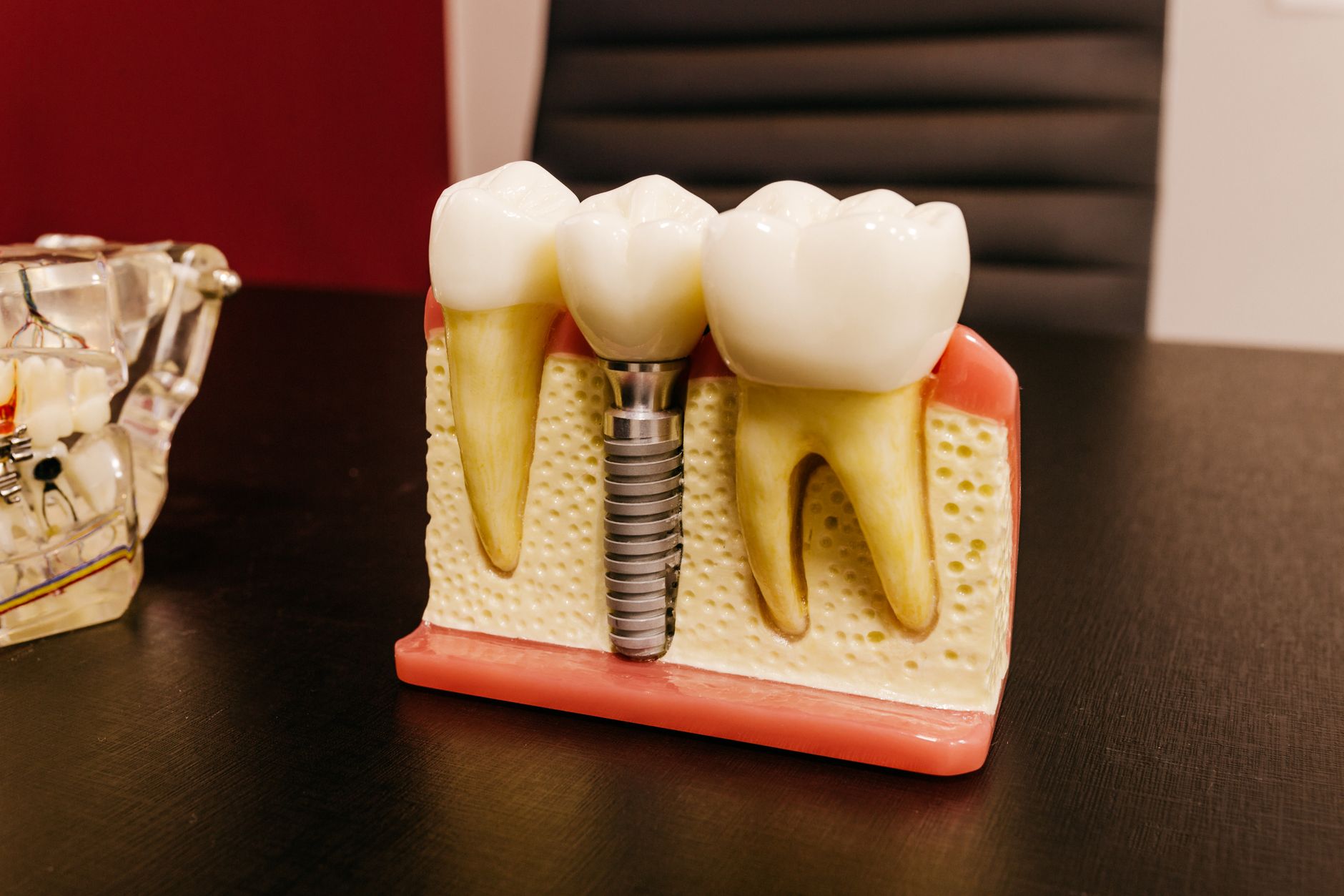 Exploring the Benefits of Dental Implants for Missing Teeth