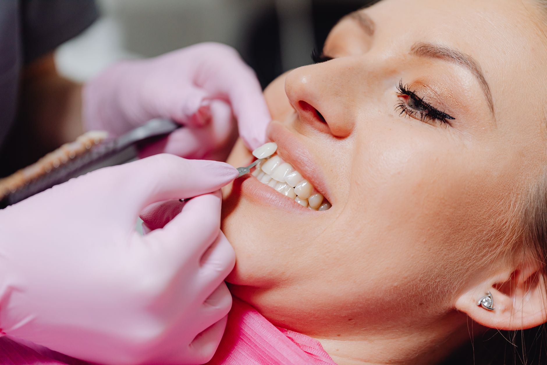 The Benefits of Dental Veneers: Enhancing Your Smile